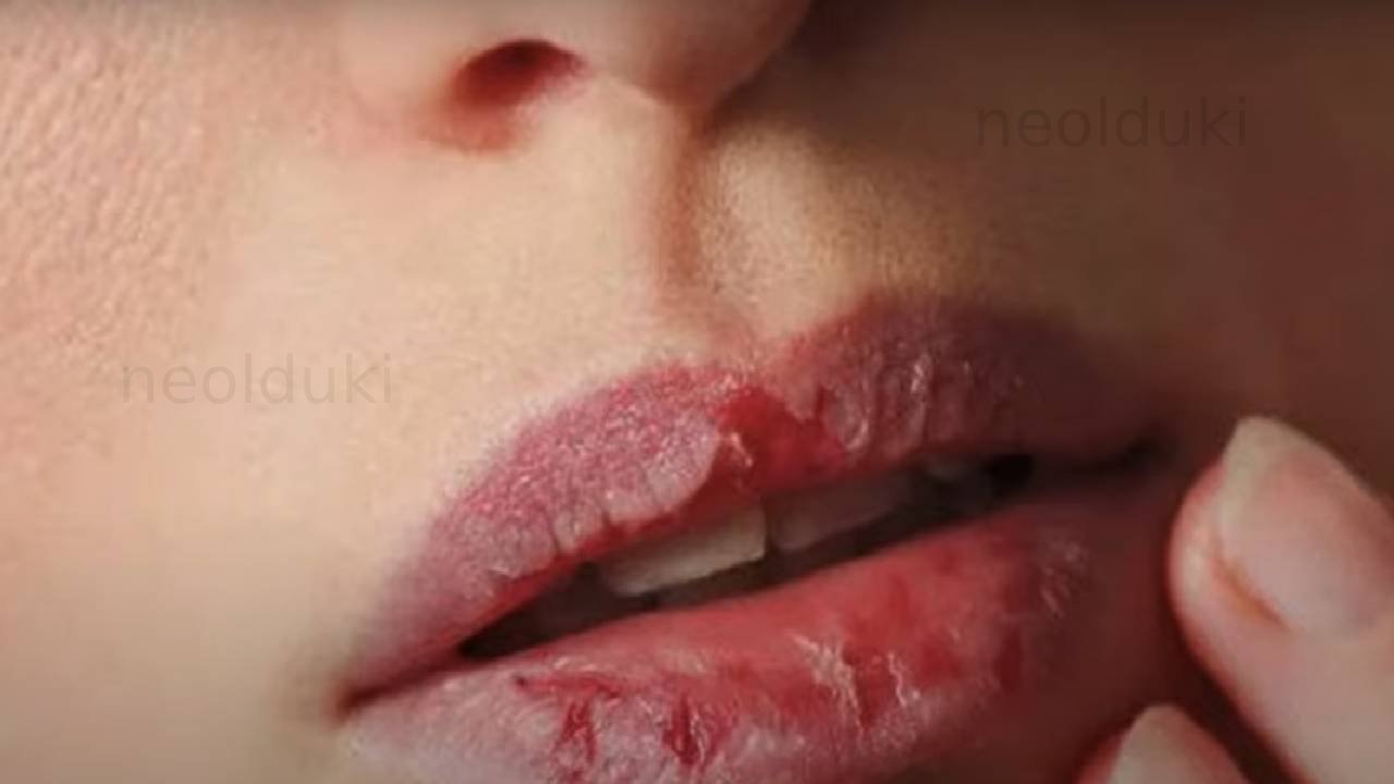 Çatlamış dudaklara ne iyi gelir?