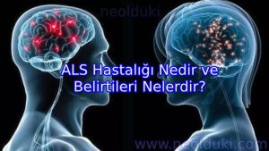 ALS Hastalığı Nedir ve Belirtileri Nelerdir?