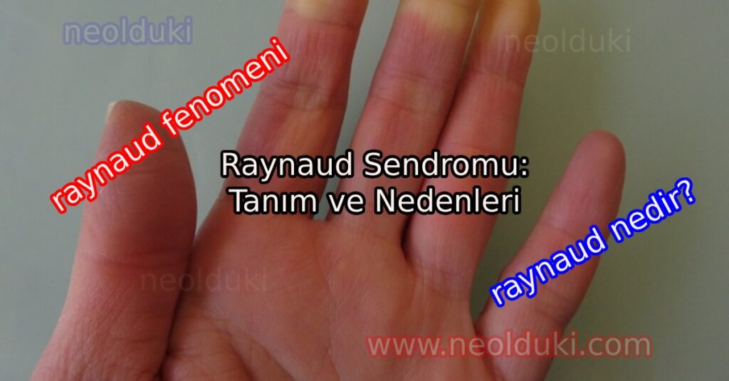 Raynaud Sendromu: Tanım ve Nedenleri,raynaud fenomeni
