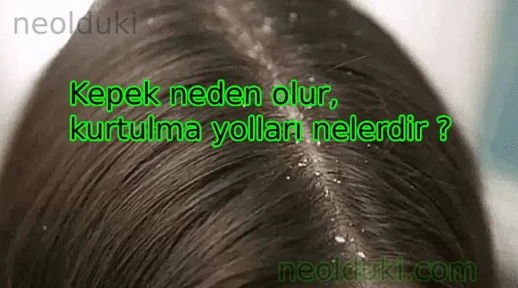 Kepek neden olur, kurtulma yolları nelerdir ?