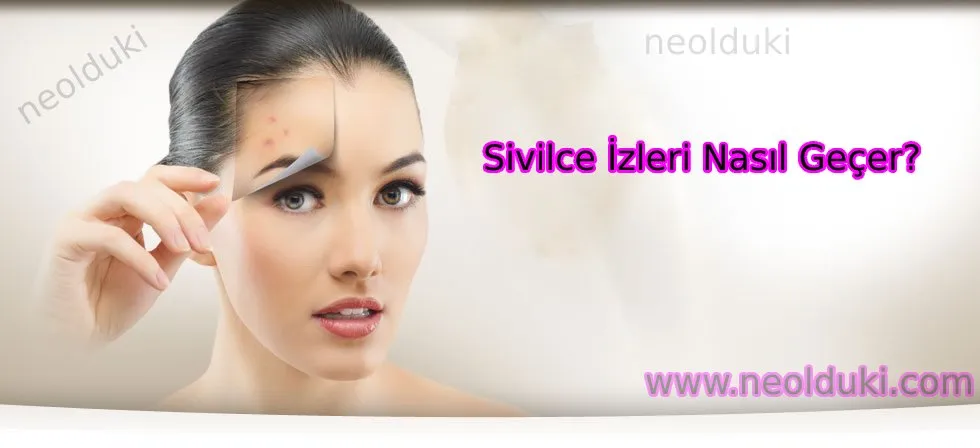 Sivilce İzleri Nasıl Geçer ?